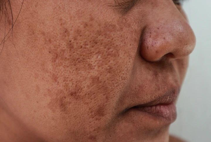Melasma