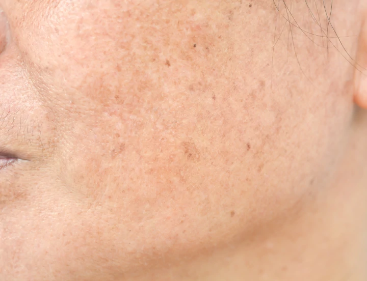 Post-inflammatory hyperpigmentation